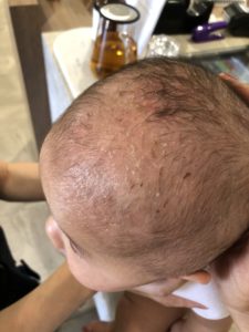 Image of baby with mild cradle cap